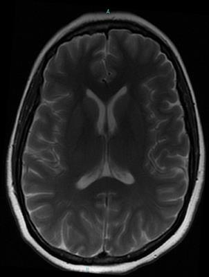 Wernicke Encephalopathy in COVID-19 Patients: Report of Three Cases